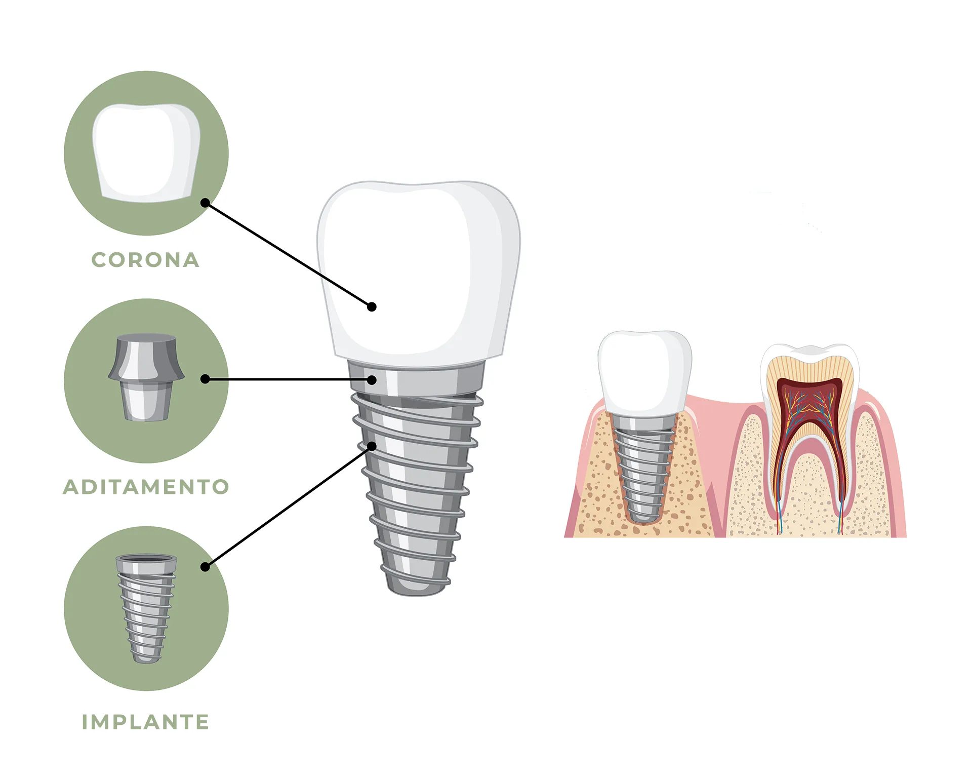 Implantes dentales en El Puerto de Santa María, Cádiz, Enyident Dentista